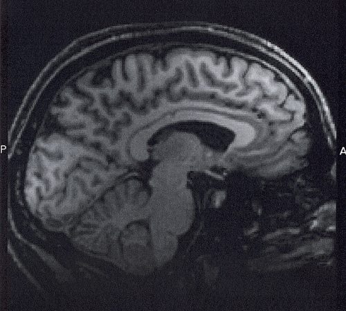 brain image missed cancer diagnosis